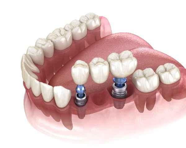 dental implants Chesterfield