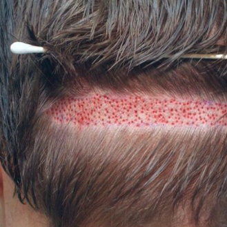 Hair Transplant 